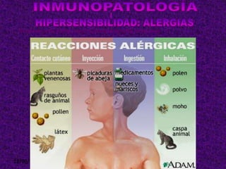 18/08/2013 18
Es una reacción intensa contra sustancias extrañas inofensivas
 