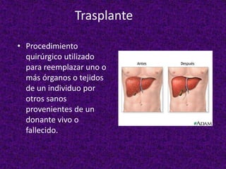 Trasplante
• Procedimiento
quirúrgico utilizado
para reemplazar uno o
más órganos o tejidos
de un individuo por
otros sanos
provenientes de un
donante vivo o
fallecido.
 