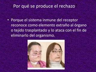 ¿Por qué se produce el rechazo?
• Porque el sistema inmune del receptor
reconoce como elemento extraño al órgano
o tejido trasplantado y lo ataca con el fin de
eliminarlo del organismo.
 