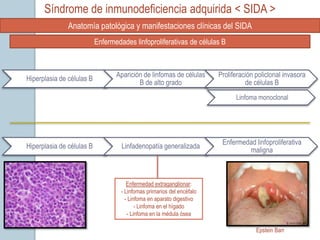 Síndrome de inmunodeficiencia adquirida < SIDA >
               Anatomía patológica y manifestaciones clínicas del SIDA
                           Enfermedades linfoproliferativas de células B



                                  Aparición de linfomas de células      Proliferación policlonal invasora
Hiperplasia de células B
                                          B de alto grado                         de células B
                                                                              Linfoma monoclonal




                                                                         Enfermedad linfoproliferativa
Hiperplasia de células B            Linfadenopatía generalizada
                                                                                 maligna



                                       Enfermedad extraganglionar:
                                    - Linfomas primarios del encéfalo
                                      - Linfoma en aparato digestivo
                                           - Linfoma en el hígado
                                       - Linfoma en la médula ósea

                                                                                      Epstein Barr
 