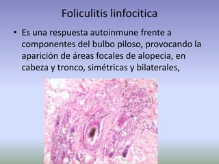 Foliculitis linfocitica
• Es una respuesta autoinmune frente a
componentes del bulbo piloso, provocando la
aparición de áreas focales de alopecia, en
cabeza y tronco, simétricas y bilaterales,
 