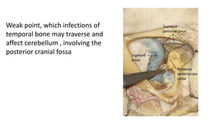 Weak point, which infections of
temporal bone may traverse and
affect cerebellum , involving the
posterior cranial fossa
 