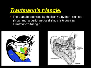 Trautsmann Triangle Inner ear anatomy.pdf