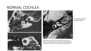 NORMAL COCHLEA
Note that the normal cochlea appears to have only 1.5
turns on the coronal scan, as a result of the oblique angle
of section in relation to the axial scans of the modiolus.
T2-weighted magnetic
resonance image
 