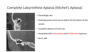 Complete Labyrinthine Aplasia (Michel’s Aplasia)
• Exceedingly rare
• Developmental arrest occurs before the formation of otic
vesicle.
• Complete absence of inner ear.
• Associated with anencephaly and thalidomide exposure.
• No CI, ABI
 