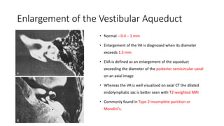 Enlargement of the Vestibular Aqueduct
• Normal – 0.4 – 1 mm
• Enlargement of the VA is diagnosed when its diameter
exceeds 1.5 mm
• EVA is defined as an enlargement of the aqueduct
exceeding the diameter of the posterior semicircular canal
on an axial image
• Whereas the VA is well visualized on axial CT the dilated
endolymphatic sac is better seen with T2-weighted MRI
• Commonly found in Type 2 Incomplete partition or
Mondini’s.
 