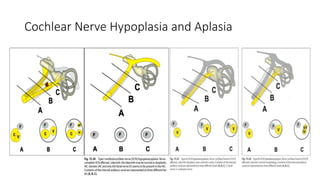 Cochlear Nerve Hypoplasia and Aplasia
 