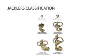 JACKLERS CLASSIFICATION
 