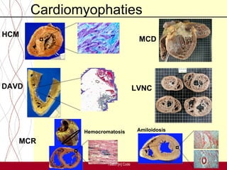Cardiomyophaties
HCM
                                          MCD




DAVD                                     LVNC




              Hemocromatosis              Amiloidosis

   MCR

                      Health [in] Code
 