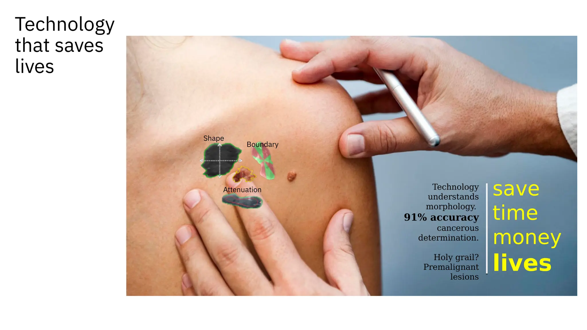Shape
Attenuation
Boundary
save
time
money
lives
Technology
understands
morphology.
91% accuracy
cancerous
determination.
Holy grail?
Premalignant
lesions
Technology
that saves
lives
 