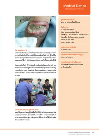 59
ที่มาของโครงการ
แผลกดทับเป็นบาดแผลเรื้อรังที่รักษาให้หายได้ยาก โดยสาเหตุมาจากการ
ถูกกดทับซึ่งส่วนใหญ่เกิดจากคนไข้ที่ช่วยเหลือตัวเองไม่ได้ เช่น ผู้ป่วยที่เป็น
อัมพาต อัมพฤกษ์ ที่มักจะนอนในท่าเดียวนานๆ หรือผู้ป่วยที่เป็นโรคทาง
สมองและไม่รู้สึกตัว จึงทำ�ให้นอนไม่เปลี่ยนท่าจนเกิดเป็นแผลกดทับขึ้นได้
ซึ่งแผลกดทับเรื้อรัง ที่จำ�เป็นต้องมีการเปลี่ยนวัสดุปิดแผลเป็นประจำ� และ
ต้องรักษาความสะอาดอยู่เสมอเพื่อลดการติดเชื้อซึ่งวัสดุปิดบาดแผลส่วนใหญ่
จะติดแห้งติดบาดแผล ส่งผลให้เวลาเปิดบาดแผลเพื่อทำ�ความสะอาดจะเกิด
บาดแผลซ้ำ�ซ้อน ทำ�ให้คนไข้ต้องทนทุกข์ทรมานในการทำ�ความสะอาด
บาดแผล
รูปแบบการสนับสนุน:
โครงการ “แปลงเทคโนโลยีเป็นทุน”
.............................................................
ดำ�เนินการ:
ภ. อดิศร อาภาสุทธิรัตน์
บริษัท โนวาเทค เฮลธ์แคร์ จำ�กัด
599/15 หมู่ 5 ถนนศรีนครินทร์ ตำ�บลสำ�โรงเหนือ
อำ�เภอเมือง จังหวัดสมุทรปราการ 10270
โทศัพท์: 02-349 4100
โทรสาร: 02-349 4105
.............................................................
มูลค่าการลงทุนเริ่มต้น:
15,000,000 บาท
.............................................................
การคุ้มครองทรัพย์สินทางปัญญา:
อยู่ระหว่างดำ�เนินการ
.............................................................
การสนับสนุนทางด้านวิชาการ:
คณะแพทยศาสตร์โรงพยาบาลรามาธิบดี
มหาวิทยาลัยมหิดล
ผลประโยชน์ทางเศรษฐกิจและสังคม
ส่งผลให้คุณภาพชีวิตของผู้ป่วยดีขึ้น ไม่ทำ�ให้ผู้ป่วยเจ็บปวดทรมานเวลาเปิด
แผล ลดโอกาสการติดเชื้อช่วยทำ�ให้แผลหายเร็วขึ้น ลดการนำ�เข้าเวชภัณฑ์
ทางการแพทย์ที่มีราคาสูงจากต่างประเทศ ที่ต้องนำ�เข้ามาใช้กับผู้ป่วยเพื่อ
รักษาแผลเป็นจำ�นวนมาก
 
