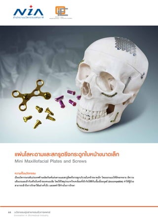 44
แผ่นโลหะดามและสกรูตรึงกระดูกใบหน้าขนาดเล็ก
Mini Maxillofacial Plates and Screws
ความเป็นนวัตกรรม
เป็นนวัตกรรมระดับประเทศด้านผลิตภัณฑ์แผ่นดามและสกรูยึดตรึงกระดูกบริเวณใบหน้าขนาดเล็ก โดยออกแบบให้มีหลกหลาย มีความ
แข็งแรงและเข้ากับสรีระใบหน้าของคนเอเชีย โดยใช้วัสดุประเภทไทเทเนียมที่เข้ากันได้ดีกับเนื้อเยื่อมนุษย์ (biocompatible) ทำ�ให้ผู้ป่วย
สามารถเข้าถึงการรักษาได้อย่างทั่วถึง และลดค่าใช้จ่ายในการรักษา
 