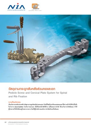 60
วัสดุดามกระดูกสันหลังส่วนคอและอก
Pedicle Screw and Cervical Plate System for Spinal
and Rib Fixation
ความเป็นนวัตกรรม
เป็นนวัตกรรมระดับประเทศด้านวัสดุดามกระดูกสันหลังส่วนคอและอก โดยใช้วัสดุไทเทเทียมและสแตนเลส ที่มีความเข้ากันได้กับเนื้อเยื่อ
ในร่างกาย (biocompatible) ร่วมกับการออกแบบ เพื่อให้แพทย์ผ่าตัดได้ง่าย ลดขั้นตอนการผ่าตัด ใช้เวลาในการผ่าตัดน้อยลง ทำ�ให้
ผู้ป่วยหายเร็วขั้นไม่ต้องอยู่โรงพยาบาลนาน โดยให้ผู้ป่วยมีบาดแผลในการผ่าตัดเล็กลงหรือน้อยลง
 