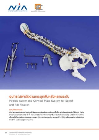 64
อุปกรณ์ผ่าตัดดามกระดูกสันหลังหลายระดับ
Pedicle Screw and Cervical Plate System for Spinal
and Rib Fixation
ความเป็นนวัตกรรม
เป็นนวัตกรรมระดับประเทศด้านอุปกรณ์ผ่าตัดดามกระดูกสันหลังหลายระดับแบบเนื้อเยื่อบาดเจ็บน้อยชนิดเจาะผ่านใต้ผิวหนัง ร่วมกับ
การออกแบบอุปกรณ์ผ่าตัดกว่า 90 ชิ้น เพื่อให้แพทย์สามารถผ่าตัดดามกระดูกสันหลังโดยไม่ต้องเปิดแผลใหญ่ แต่ใช้การเจาะผ่านผิวหนัง
เพื่อสอดใส่เกียวชนิดพิเศษ (pedicular screw) ที่มีความแข็งแรงและยึดดามกระดูกได้ ทำ�ให้ผู้ป่วยมีบาดแผลในการผ่าตัดเล็กลง
หายเร็วขึ้น และไม่ต้องอยู่โรงพยาบาลนาน
 