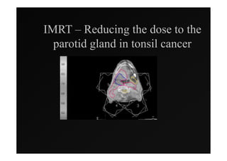 IMRT – Reducing the dose to the
  parotid gland in tonsil cancer
 