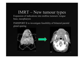 IMRT – New tumour types
Expansion of indications into midline tumours: tongue
base, nasopharynx
PARSPORT II to investigate feasibility of bilateral parotid
gland sparing
 