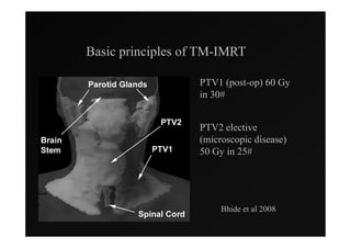 Basic principles of TM-IMRT

                   PTV1 (post-op) 60 Gy
                   in 30#


                   PTV2 elective
                   (microscopic disease)
                   50 Gy in 25#




                        Bhide et al 2008
 