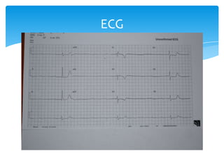 ECG

 