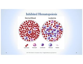Inhibited Hematopoiesis
2016 TNK Children’s Foundation (http://huggedandkissed.org/leukemia/)
 