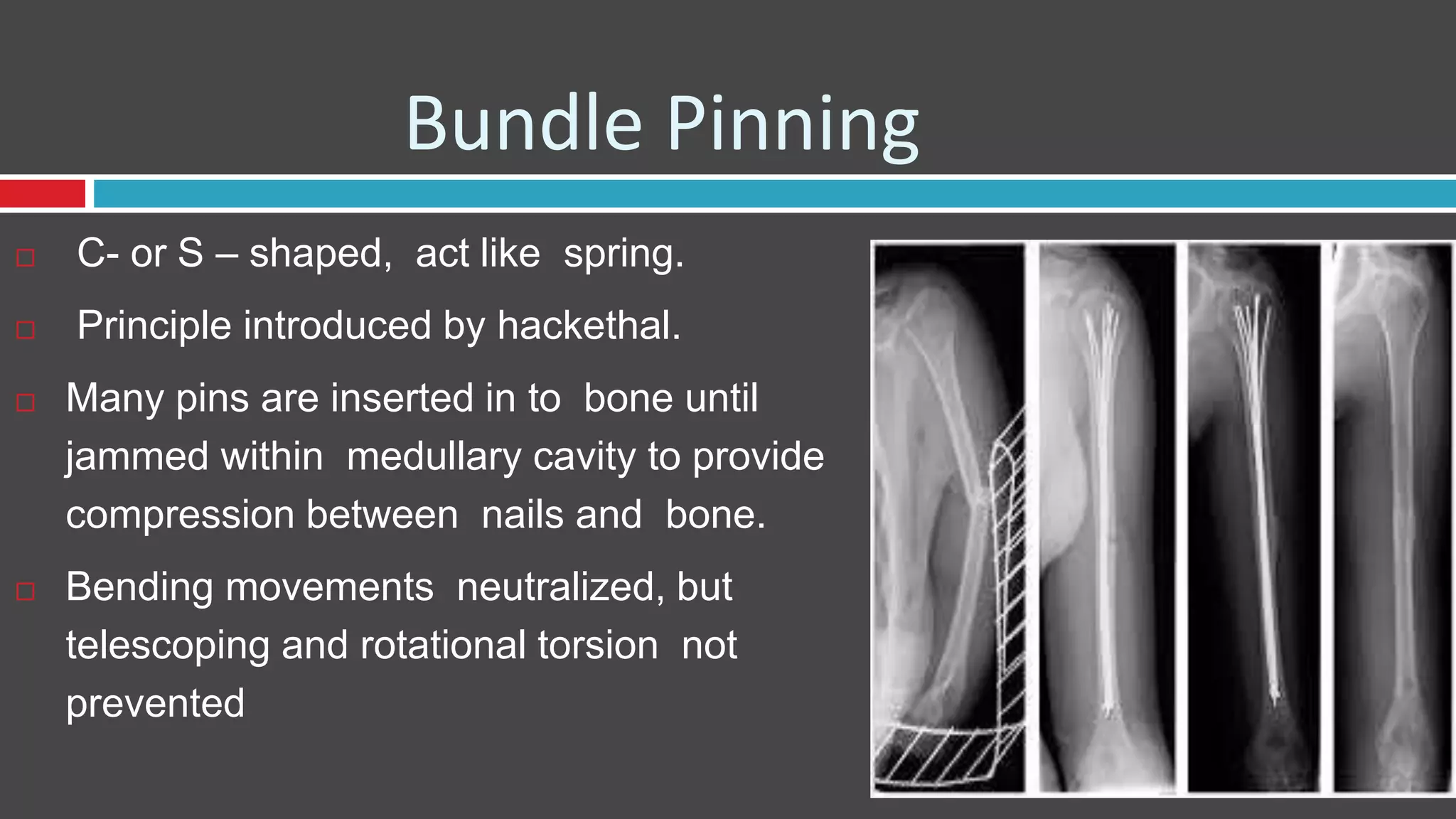 Bundle Pinning
 C- or S – shaped, act like spring.
 Principle introduced by hackethal.
 Many pins are inserted in to bone until
jammed within medullary cavity to provide
compression between nails and bone.
 Bending movements neutralized, but
telescoping and rotational torsion not
prevented
 