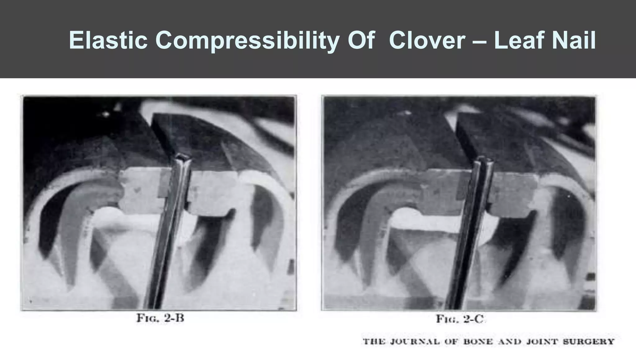 Elastic Compressibility Of Clover – Leaf Nail
 