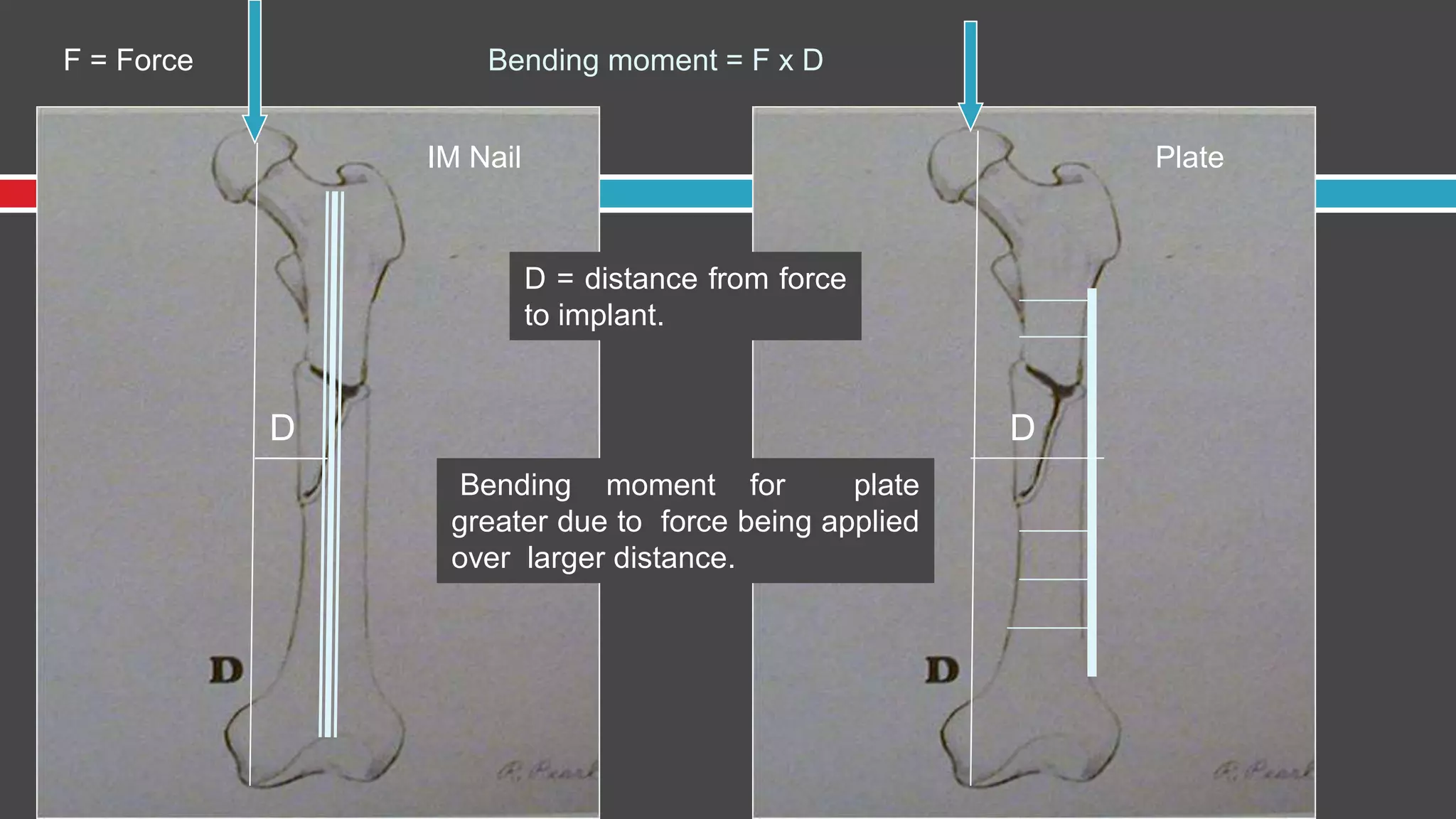 D
F = Force Bending moment = F x D
D
PlateIM Nail
Bending moment for plate
greater due to force being applied
over larger distance.
D = distance from force
to implant.
 