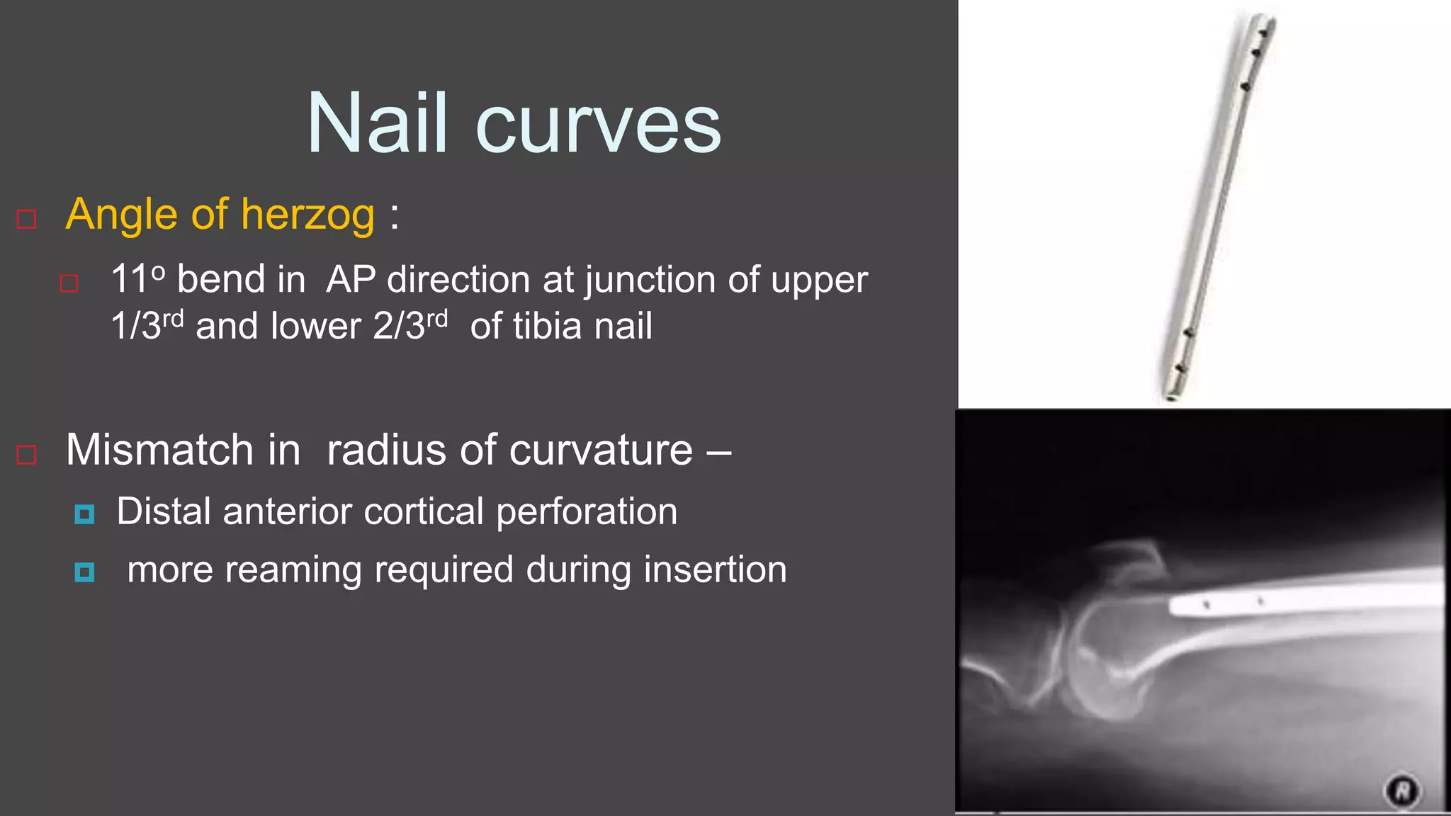 Nail curves
 Angle of herzog :
 11o bend in AP direction at junction of upper
1/3rd and lower 2/3rd of tibia nail
 Mismatch in radius of curvature –
 Distal anterior cortical perforation
 more reaming required during insertion
 