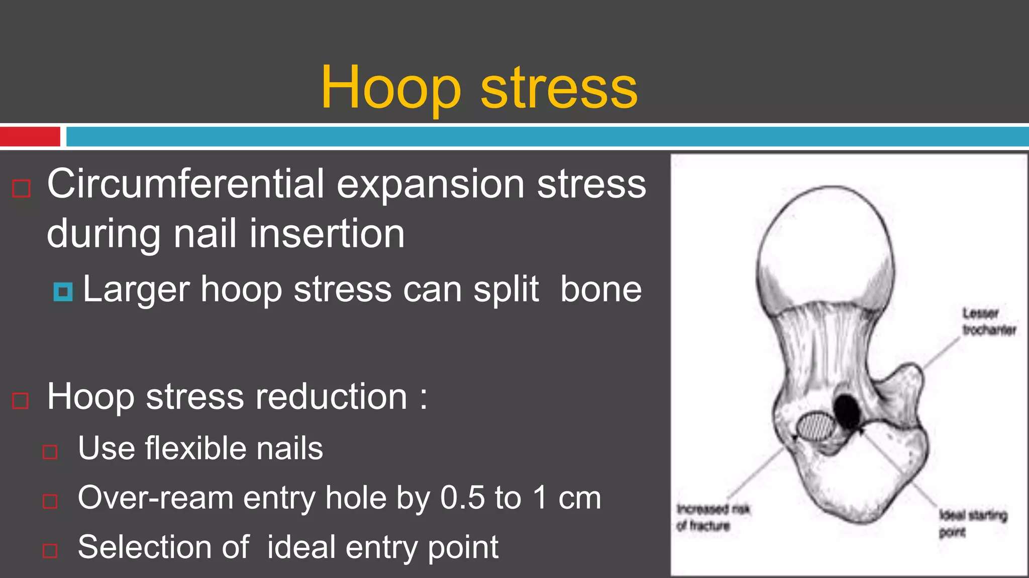 Hoop stress
 Circumferential expansion stress
during nail insertion
 Larger hoop stress can split bone
 Hoop stress reduction :
 Use flexible nails
 Over-ream entry hole by 0.5 to 1 cm
 Selection of ideal entry point
 