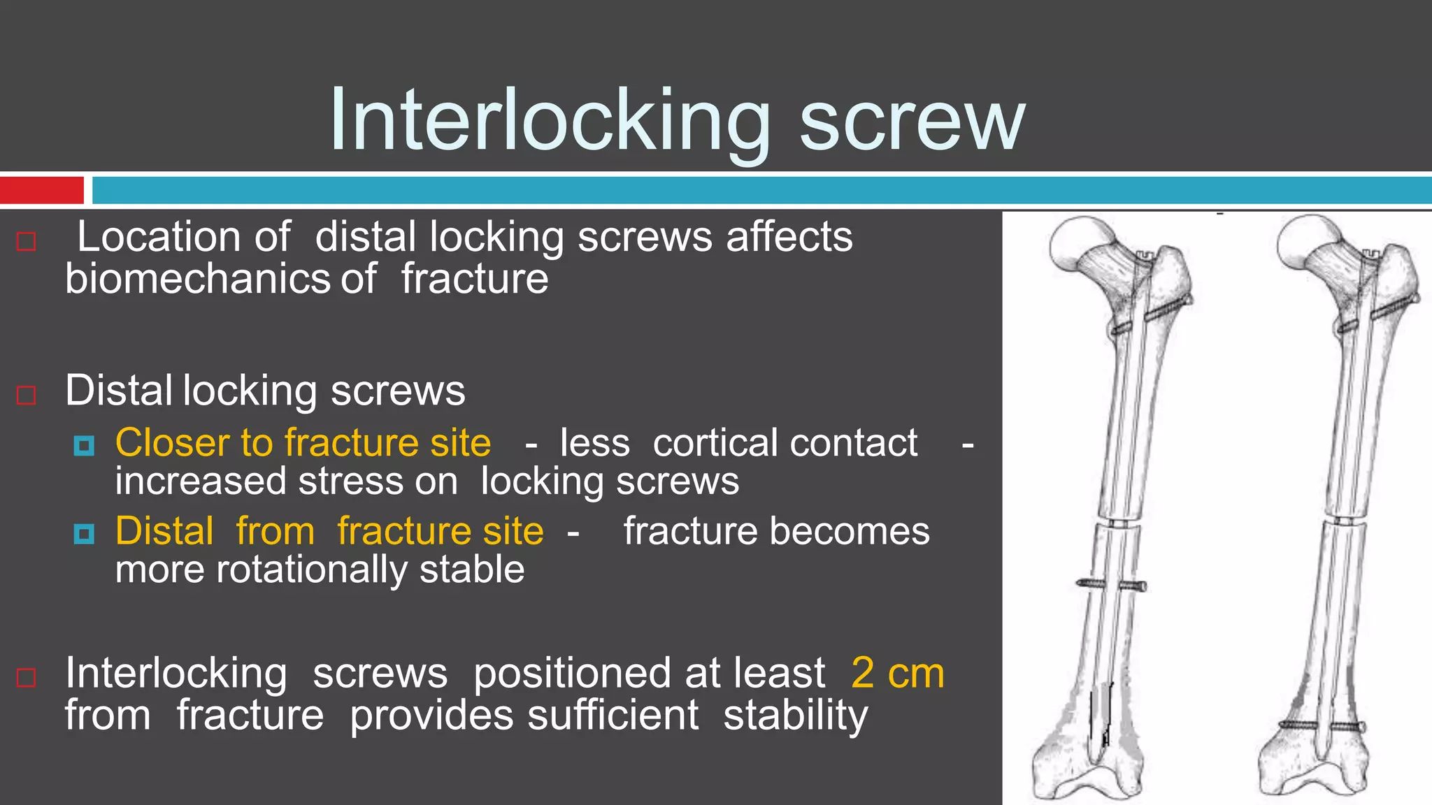 Interlocking screw
 Location of distal locking screws affects
biomechanics of fracture
 Distal locking screws
 Closer to fracture site - less cortical contact -
increased stress on locking screws
 Distal from fracture site - fracture becomes
more rotationally stable
 Interlocking screws positioned at least 2 cm
from fracture provides sufficient stability
 