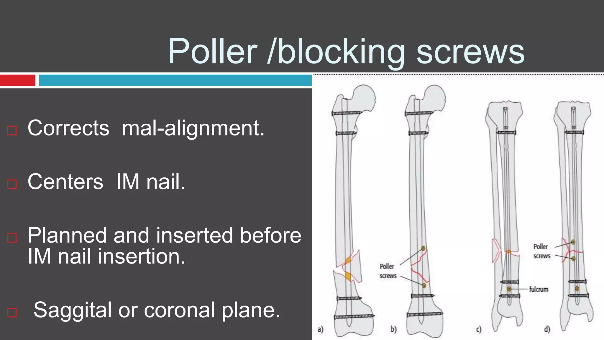 Poller /blocking screws
 Corrects mal-alignment.
 Centers IM nail.
 Planned and inserted before
IM nail insertion.
 Saggital or coronal plane.
 