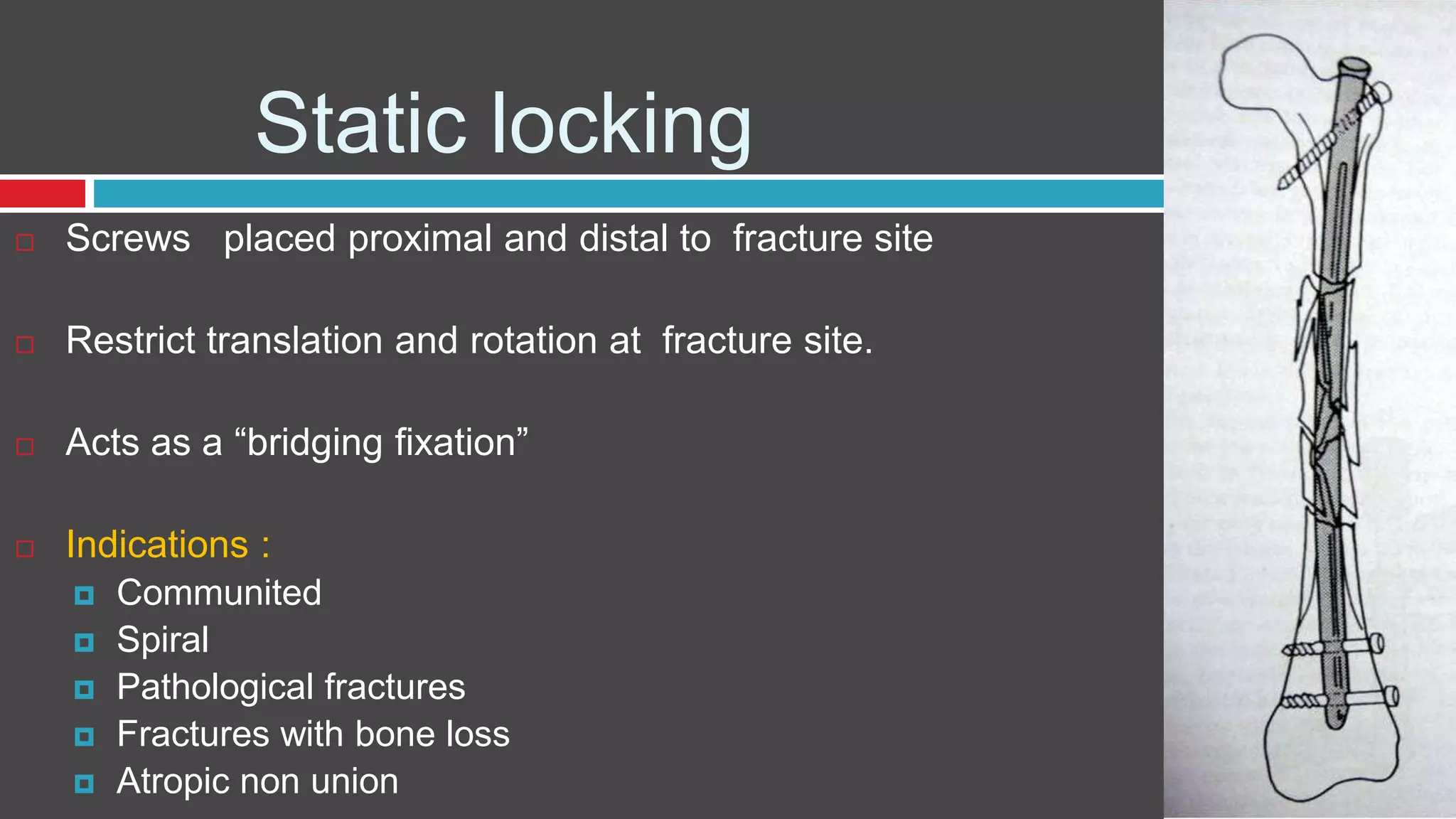 Static locking
 Screws placed proximal and distal to fracture site
 Restrict translation and rotation at fracture site.
 Acts as a “bridging fixation”
 Indications :
 Communited
 Spiral
 Pathological fractures
 Fractures with bone loss
 Atropic non union
 