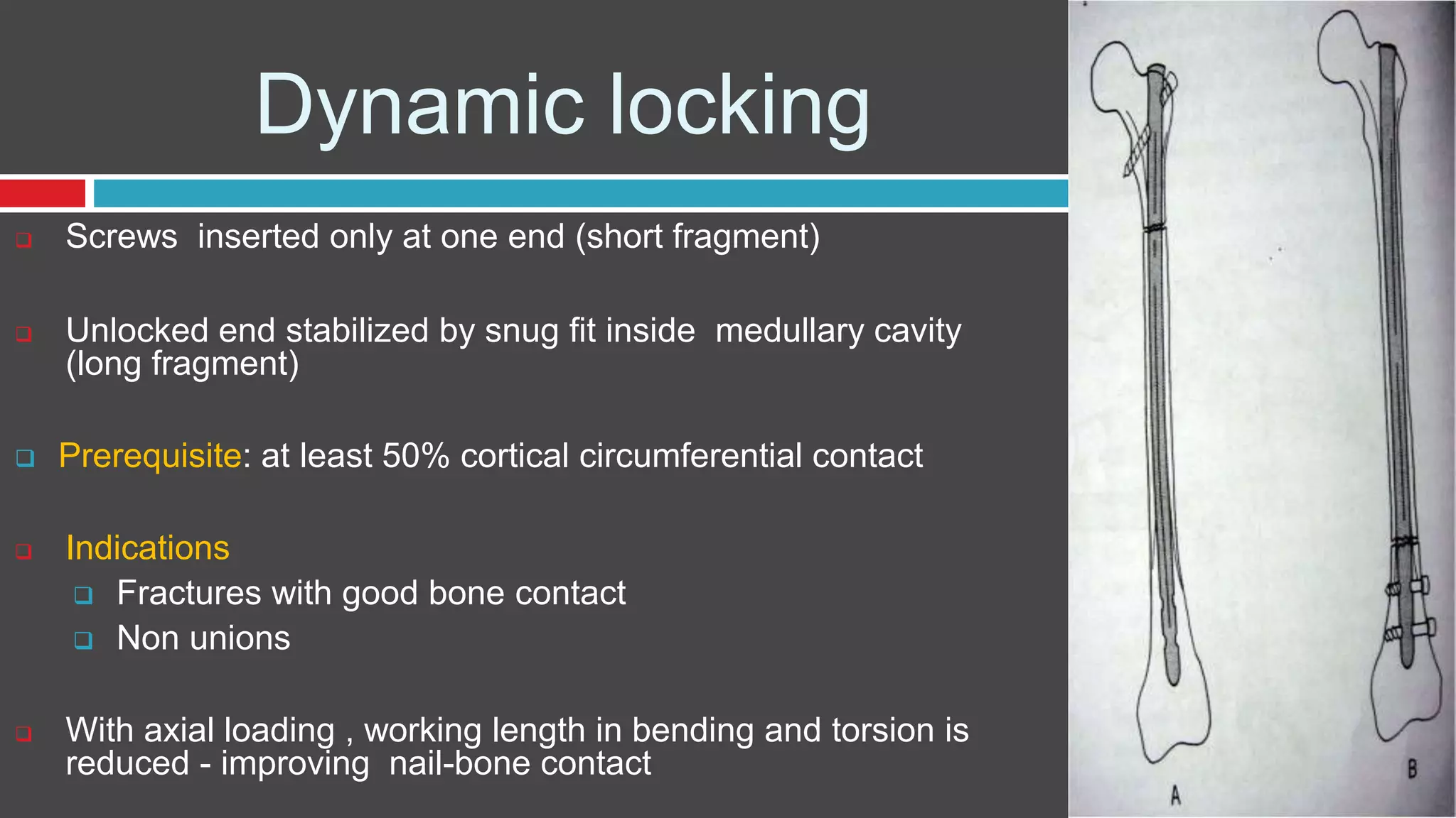 Dynamic locking
 Screws inserted only at one end (short fragment)
 Unlocked end stabilized by snug fit inside medullary cavity
(long fragment)
 Prerequisite: at least 50% cortical circumferential contact
 Indications
 Fractures with good bone contact
 Non unions
 With axial loading , working length in bending and torsion is
reduced - improving nail-bone contact
 