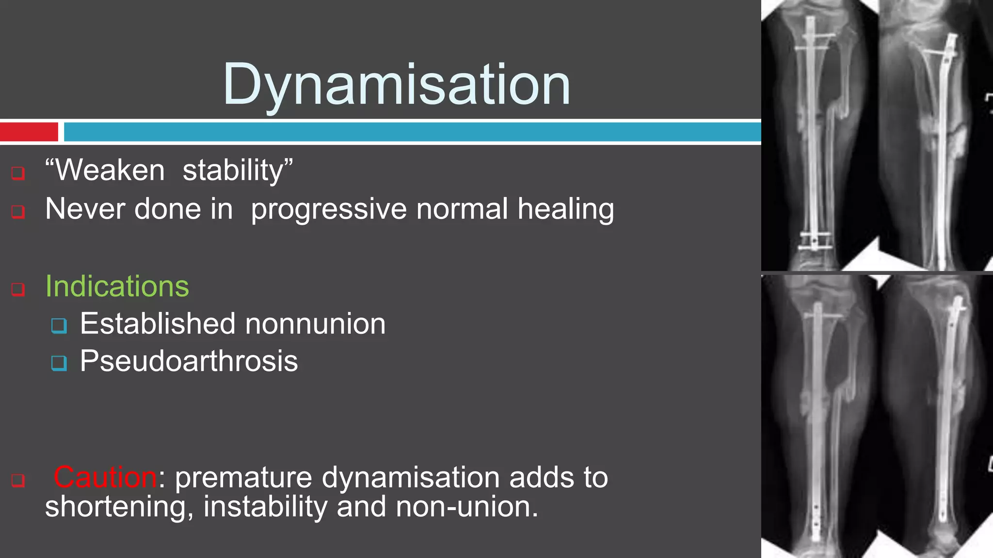 Dynamisation
 “Weaken stability”
 Never done in progressive normal healing
 Indications
 Established nonnunion
 Pseudoarthrosis
 Caution: premature dynamisation adds to
shortening, instability and non-union.
 