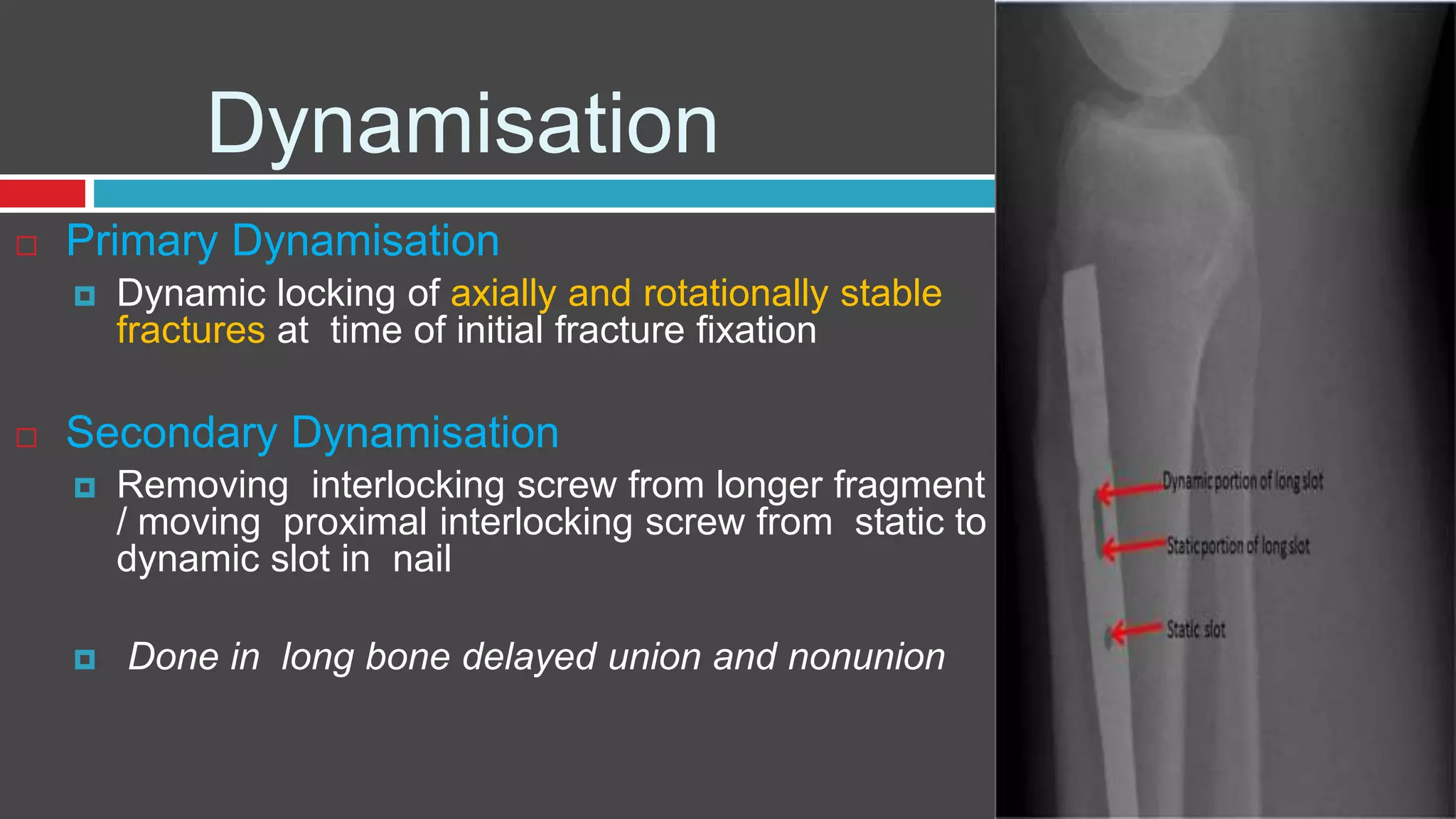 Dynamisation
 Primary Dynamisation
 Dynamic locking of axially and rotationally stable
fractures at time of initial fracture fixation
 Secondary Dynamisation
 Removing interlocking screw from longer fragment
/ moving proximal interlocking screw from static to
dynamic slot in nail
 Done in long bone delayed union and nonunion
 