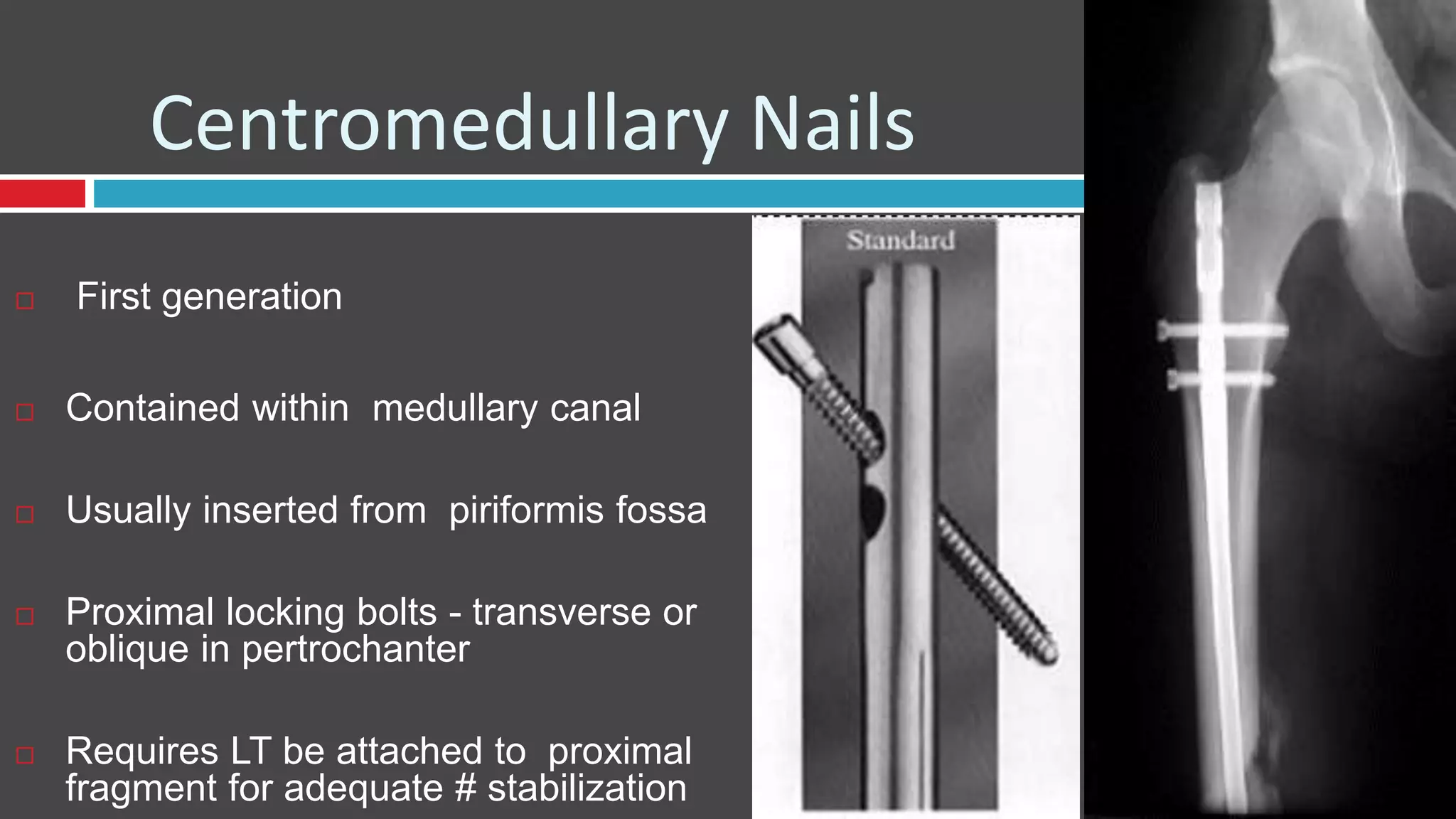 Centromedullary Nails
 First generation
 Contained within medullary canal
 Usually inserted from piriformis fossa
 Proximal locking bolts - transverse or
oblique in pertrochanter
 Requires LT be attached to proximal
fragment for adequate # stabilization
 