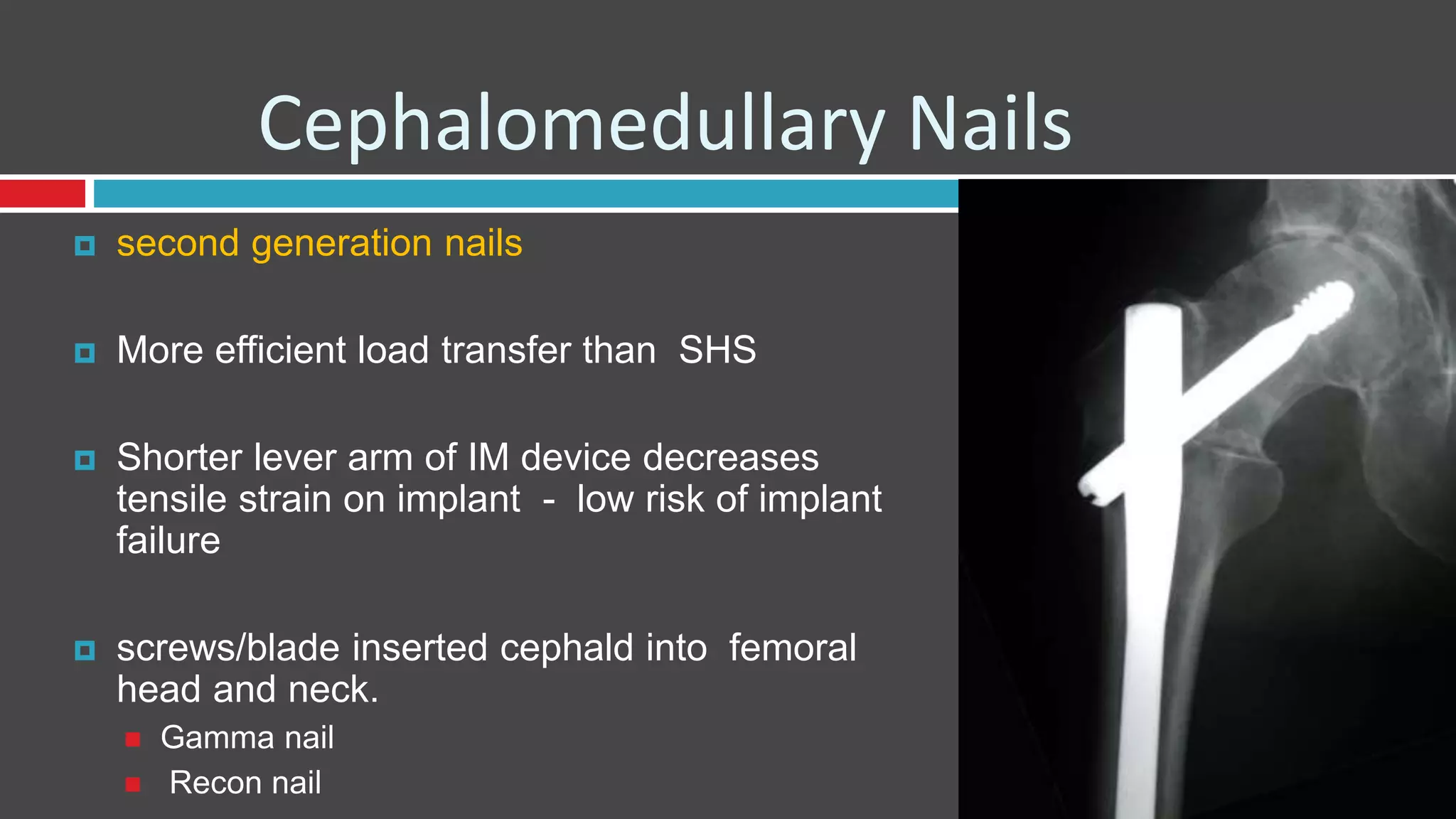 Cephalomedullary Nails
 second generation nails
 More efficient load transfer than SHS
 Shorter lever arm of IM device decreases
tensile strain on implant - low risk of implant
failure
 screws/blade inserted cephald into femoral
head and neck.
 Gamma nail
 Recon nail
 