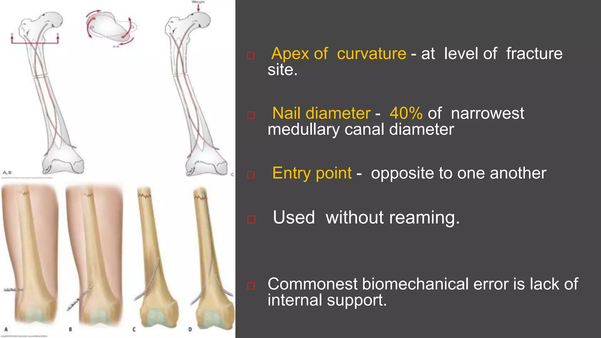 Opposite  Apex of curvature - at level of fracture
site.
 Nail diameter - 40% of narrowest
medullary canal diameter
 Entry point - opposite to one another
 Used without reaming.
 Commonest biomechanical error is lack of
internal support.
 