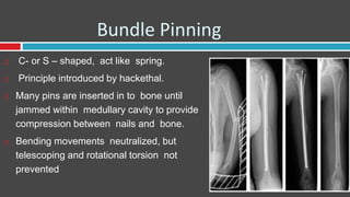 Bundle Pinning
 C- or S – shaped, act like spring.
 Principle introduced by hackethal.
 Many pins are inserted in to bone until
jammed within medullary cavity to provide
compression between nails and bone.
 Bending movements neutralized, but
telescoping and rotational torsion not
prevented
 
