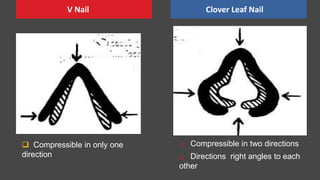  Compressible in two directions
 Directions right angles to each
other
V Nail Clover Leaf Nail
 Compressible in only one
direction
 