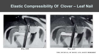 Elastic Compressibility Of Clover – Leaf Nail
 