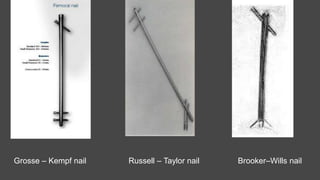 Grosse – Kempf nail Russell – Taylor nail Brooker–Wills nail
 