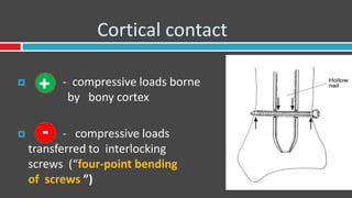 Cortical contact
 - compressive loads borne
by bony cortex
 - compressive loads
transferred to interlocking
screws (“four-point bending
of screws ”)
+
-
 