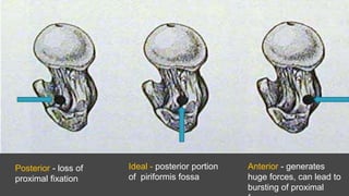Posterior - loss of
proximal fixation
Ideal - posterior portion
of piriformis fossa
Anterior - generates
huge forces, can lead to
bursting of proximal
 