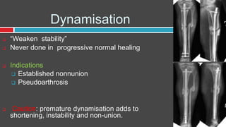 Dynamisation
 “Weaken stability”
 Never done in progressive normal healing
 Indications
 Established nonnunion
 Pseudoarthrosis
 Caution: premature dynamisation adds to
shortening, instability and non-union.
 