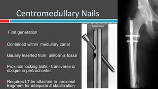 Centromedullary Nails
 First generation
 Contained within medullary canal
 Usually inserted from piriformis fossa
 Proximal locking bolts - transverse or
oblique in pertrochanter
 Requires LT be attached to proximal
fragment for adequate # stabilization
 