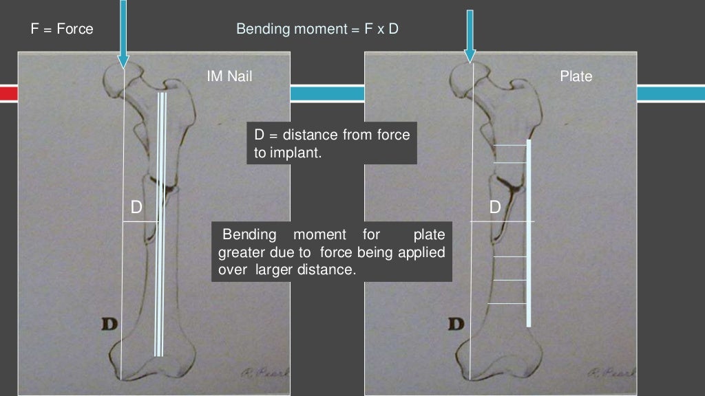 brooker-wills interlocking intramedullary nail design