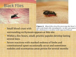 Black Flies
 Small blood crust with
surrounding ecchymosis appears at bite site.
 Within a few hours, small, pruritic papules develop lasting
several days.
 Severe reactions with marked oedema of limbs and
constitutional upset occasionally occur and sometimes
nodules and eczematous areas persist for several months
 