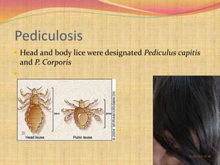 Pediculosis
 Head and body lice were designated Pediculus capitis
and P. Corporis

 