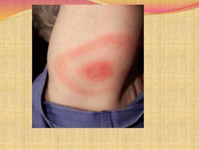 Insect Bite Reactions