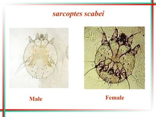 sarcoptes scabei
Female
Male
 